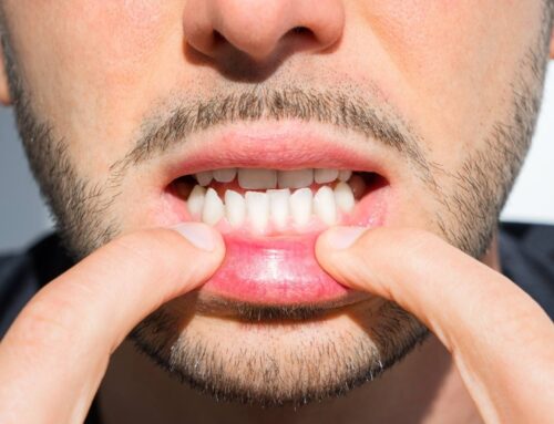Common Teeth Alignment Problems