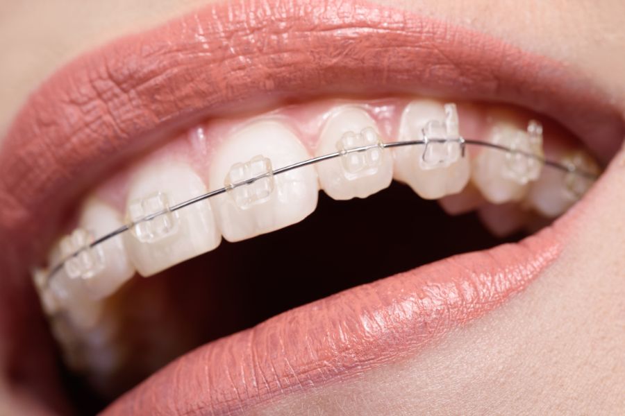 Deciding Between Metal and Ceramic Braces: Which is Right for You