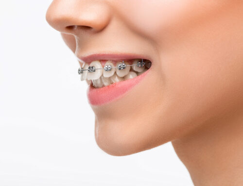 How Do Braces Correct An Overbite?