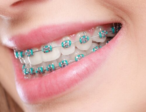 Orthodontic Troubleshooting: How to Handle Common Braces Issues