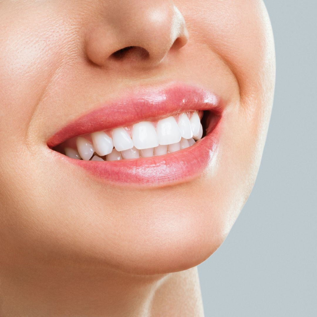 Opalescence Teeth Whitening image